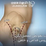 تفاوت تعویض مفصل لگن از روش قدامی و خلفی