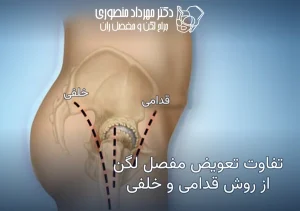 تفاوت تعویض مفصل لگن از روش قدامی و خلفی