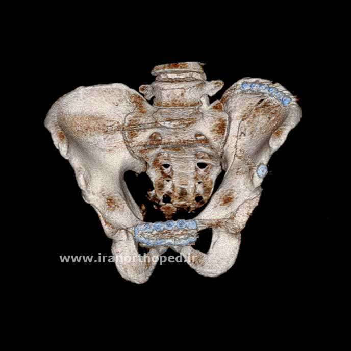 جراحی و فیکس شدن شکستگی شکستگی  حلقه لگنی با پیچ و پلاک