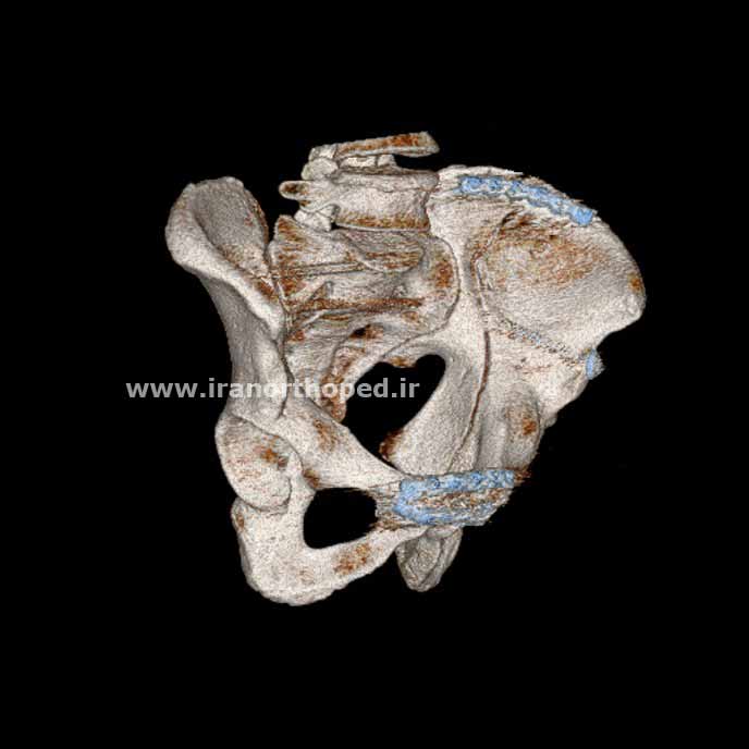 جراحی و فیکس شدن شکستگی شکستگی حلقه لگن با پیچ و پلاک